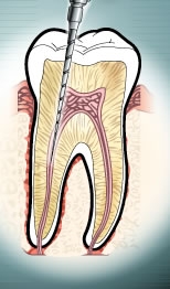 Click image for larger version

Name:	endodoncia[1].JPG
Views:	298
Size:	31.3 KB
ID:	245817