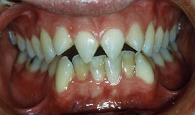 Click image for larger version

Name:	6 tooth filing.jpg
Views:	1305
Size:	36.0 KB
ID:	246130