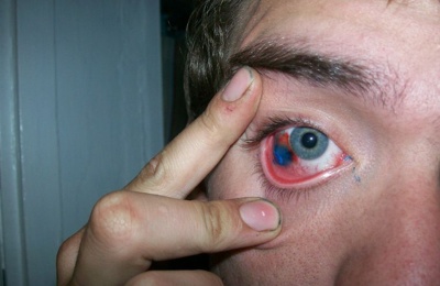 Click image for larger version

Name:	3 corneal tattooing.jpg
Views:	4402
Size:	38.1 KB
ID:	246132
