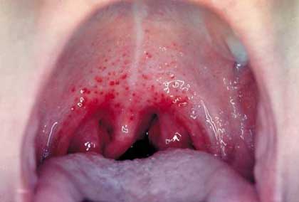 Click image for larger version

Name:	strepthroat1.jpg
Views:	177
Size:	9.6 KB
ID:	246592
