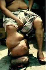 Click image for larger version

Name:	1 Elephantiasis.jpg
Views:	2248
Size:	6.7 KB
ID:	249559