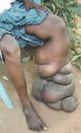 Click image for larger version

Name:	1b Elephantiasis2.jpg
Views:	1641
Size:	5.6 KB
ID:	249560